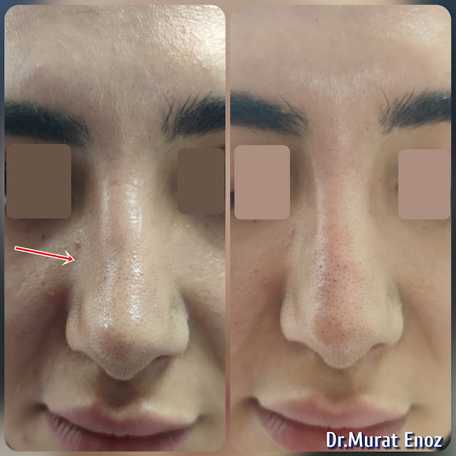 Non-surgical rhinoplasty with temporary filler in Istanbul,Injectable nose job,Liquid Rhinoplasty,