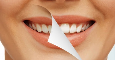 Khi nào nên tẩy trắng răng?