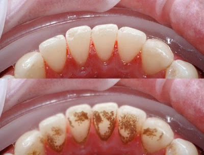 Vì sao vôi răng gây hôi miệng?