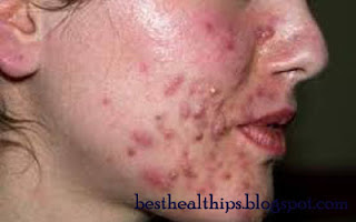 adult acne-pimples