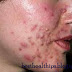 Tips to Cure Adult Acne With Herbal Remedies