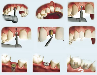 Chuyên gia phân tích nhổ răng bao lâu thì bị tiêu xương 1