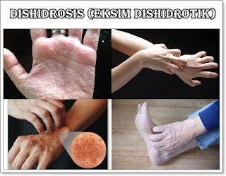 Pengobatan Dishidrosis