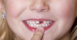 Cấy ghép implant cho người thiếu răng bẩm sinh- 1