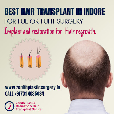 Hair transplant Indore