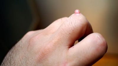 Warts, Precautions of warts, treatment of warts