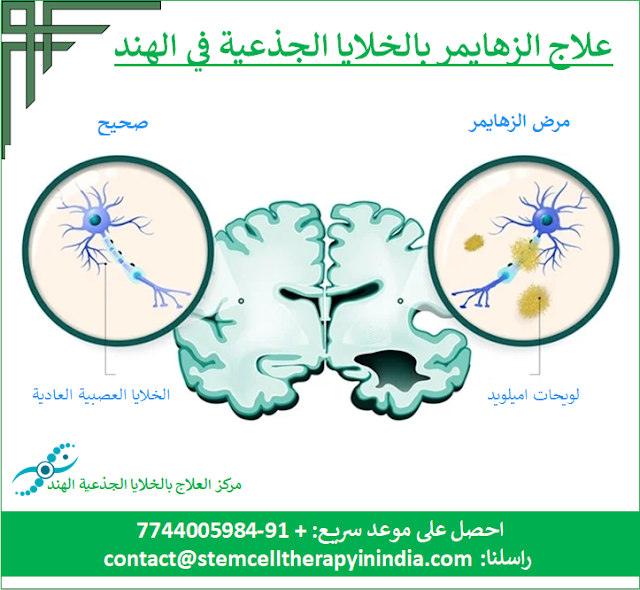 علاج الزهايمر بالخلايا الجذعية في الهند