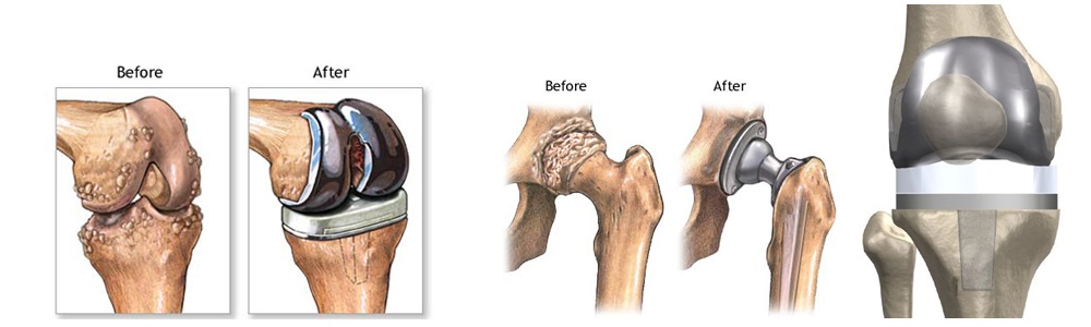 knee surgery in indirapuram