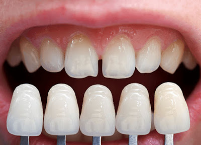 Làm răng sứ thẩm mỹ có đau không?