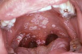  white spots in mouth causes, symptoms, and treatment