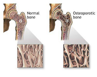 osteoporosis