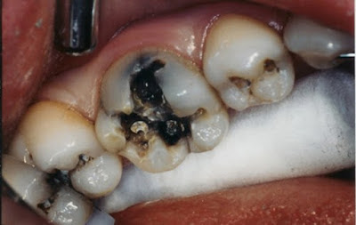 Nguyên nhân gây sâu răng hàm dưới là gì?
