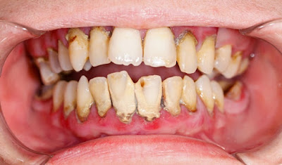 Mảng bám đen ở chân răng là gì? Có ảnh hưởng gì không?-1