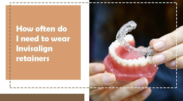 How Long Do I Have to Wear Invisalign Retainer
