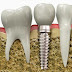 Cấy ghép răng implant khi nào?