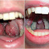 World's Largest Tonsils Set in Guinness Book of World Records