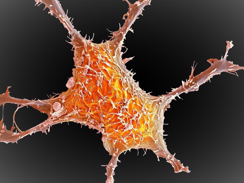 Imágen microscópica de una célula de cáncer de mama