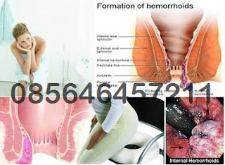 Komplikasi Penyakit Hemoroid Jika dibiarkan