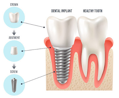 gia-tien-trong-rang-implant