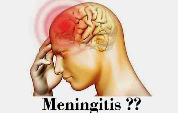 Mengenal Penyakit Meningitis mulai dari Penyebab, Gejala, Pengobatan dan Pencegahannya.