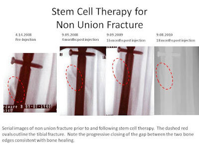 Efek stem cell therapy pada fraktur non union