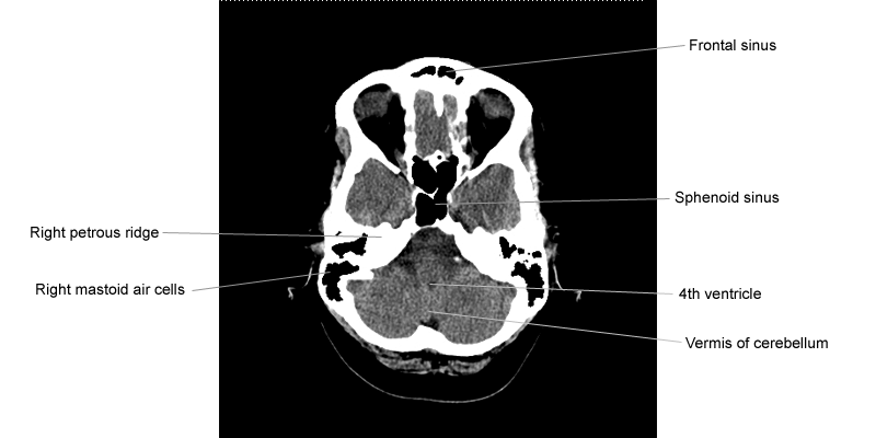 Cafe Radiologi: Anatomi dari gambaran CT Scan Kepala