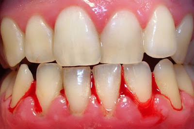 Nguyên nhân gây bệnh viêm nướu răng 