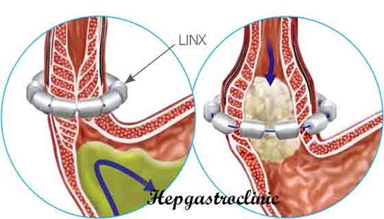 GERD Symptoms, Treatment, Causes, Diet & More