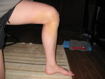 'Knee'd to Know Basis: My Personal Experience of ACL Tear ...