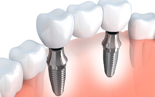 Các tiêu chí xác định làm răng Implant ở đâu tốt