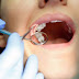 Nhổ răng khôn có nguy hiểm không? Những điều cần biết khi nhổ răng khôn