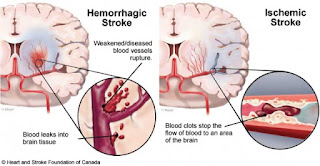obat herbal gejala stroke mujarab dan aman, obat herbal gejala stroke mujarab, obat herbal gejala stroke aman