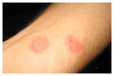 Bed Bug Bites On Dark Skin People Bed bugs molted skin,