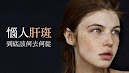 惱人肝斑 到底該何去何從