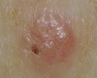squamous cell skin cancer pictures