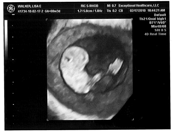 Baby Ultrasound 9 Weeks