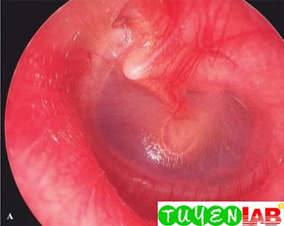 Left tympanic membrane (TM) of a 9-year-old girl with recurrent acute otitis media and chronic TM retractions prior to polyethylene (PE) tube placement