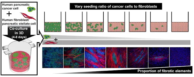 Image Attribute: Pancreatic cancer cells (green areas) and fibroblasts (non-green areas) were mixed in specialized culture vessels to create a novel three-dimensional cell culture model of pancreatic cancer in the laboratory. The cells were mixed at various ratios to enable the tweaking of the amount of fibrosis, from almost no fibrotic tissue (bottom panel, leftmost image) to almost completely fibrotic tissue (bottom panel, 2nd image from the left). When cultured together with cancer cells, fibroblasts began to express a protein characteristic of cancer tissue (red) that was not observed when fibroblasts were cultured alone (bottom panel, left most image). The model thus successfully captures and allows the analysis of the interactions between cancer cells and fibroblasts that drive the formation of fibrotic tissue.