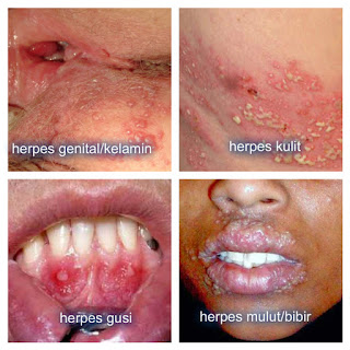 cara mengobati herpes zoster , cara mengobati herpes di wajah , cara mengobati herpes genital , cara mengobati herpes di bibir , cara mengobati herpes secara alami , cara mengobati herpes pada bayi , cara mengobati herpes simplex , cara mengobati herpes pada anak , cara mengobati herpes pada kemaluan pria