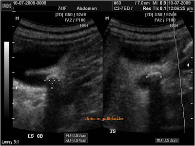 common bile duct cystic duct. cystic duct and common