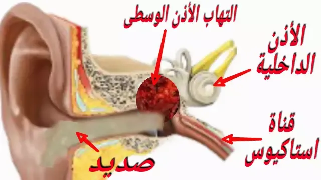 اعراض وعلامات التهاب الأذن الوسطى