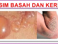 Cara Mengobati Gatal Karena Eksim Dengan Obat Herbal