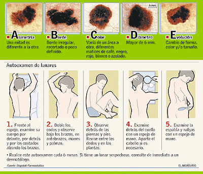 melanoma skin cancer in