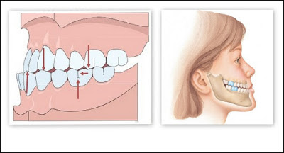 Phẫu thuật chỉnh hàm răng dưới chìa ra 