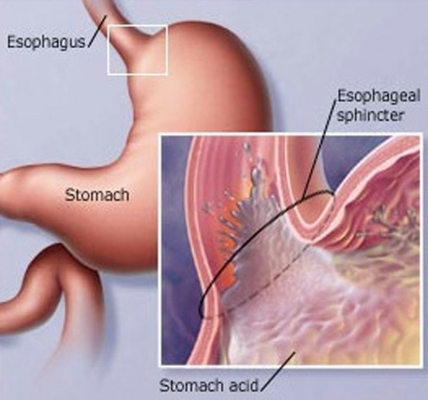 How Does Weight Loss Help With Reflux