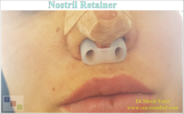 Nostril Retainer (Nose Shaping Apparatus)