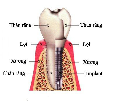Thế nào là chịu lực tức trên implant?