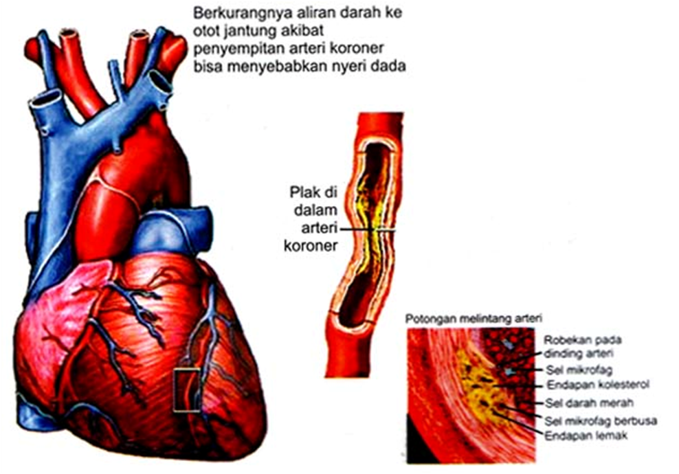 Jenis jenis Penyakit Dalam Penyakit dan Gambar  Jantung 