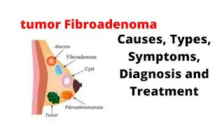 What Is Fibroadenoma