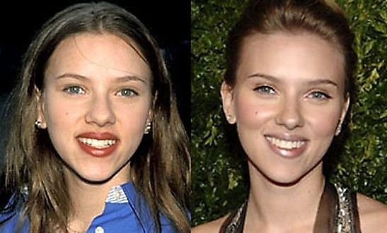 scarlettjohannsonbefore%255B1%255D Hollywood Celebs Before & After Surgery